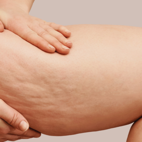 Unveiling The Cellulite Site: A Journey of Courage, Compassion, and Commitment